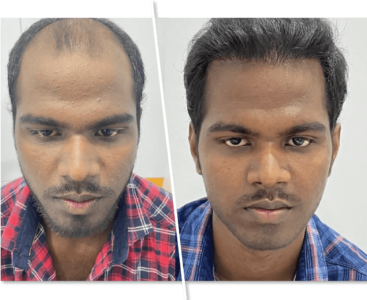 imgi_2_Hair-Transplantation_1-367x300