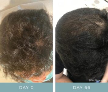 imgi_3_Hair-Loss-Aswain-BA-1024x870-1-353x300