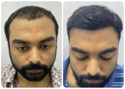 imgi_7_prp-hair-treatment-before-after-3-400x286